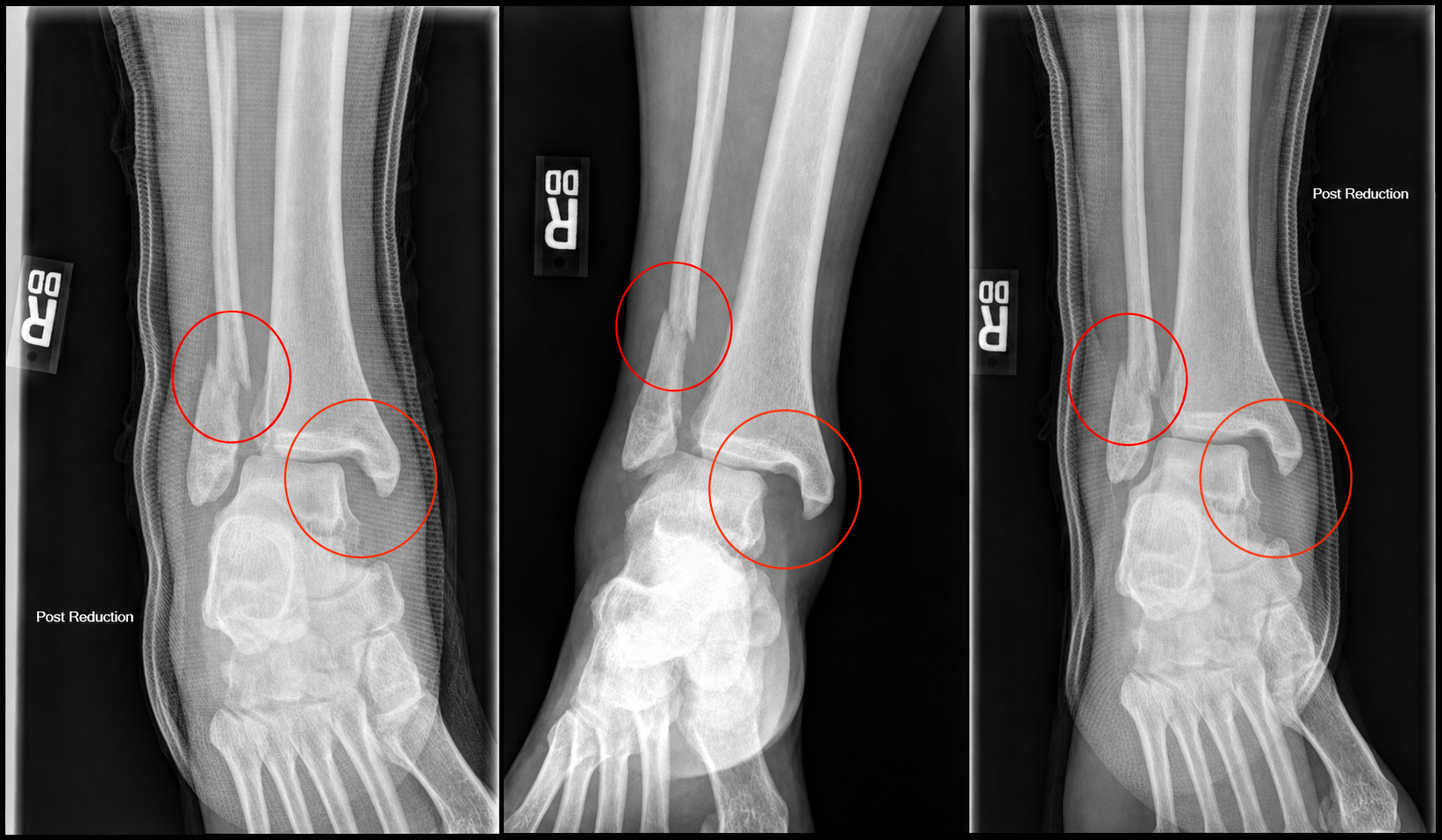 One Year Later: Breaking my Ankle (Pt. 1)